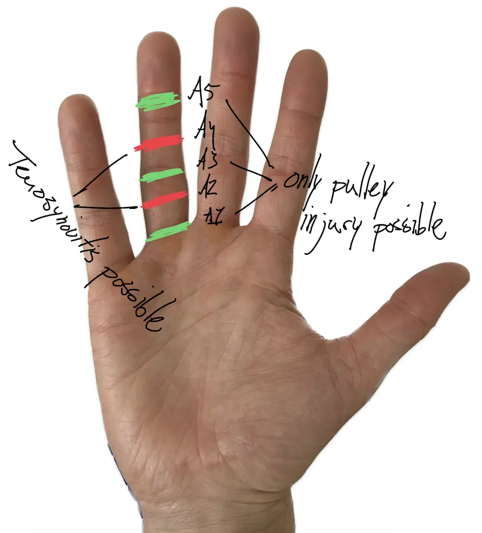 Schmerzort der Sehnenscheidenentzündung.