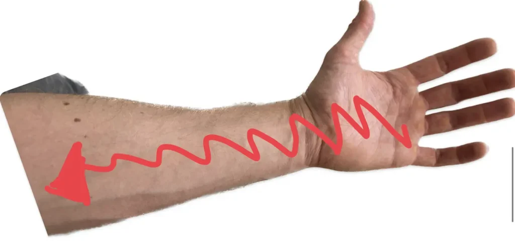 Schmerzort der Sehnenscheidenentzündung.